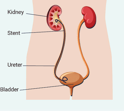 Kideny stent