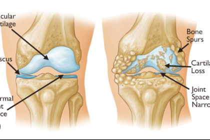 osteoarthritis