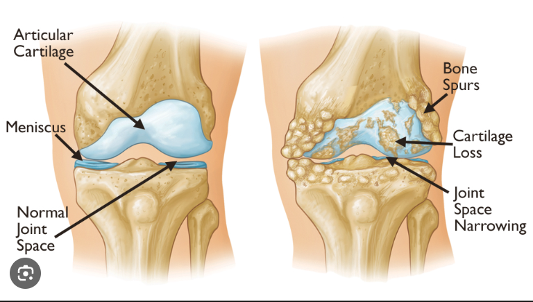 osteoarthritis