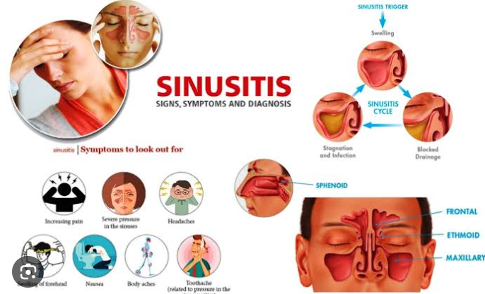 sinusitis