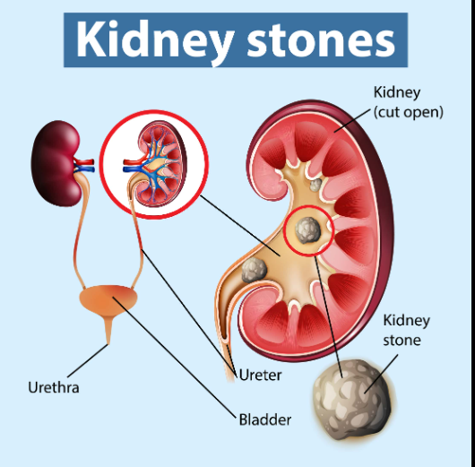 Kidney stone