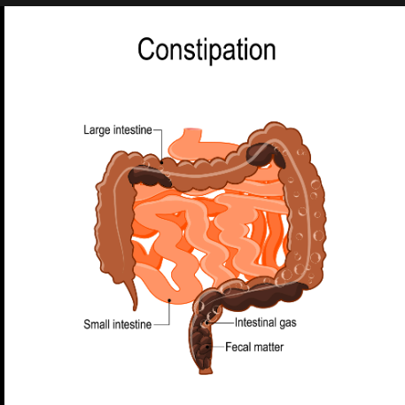 constipation