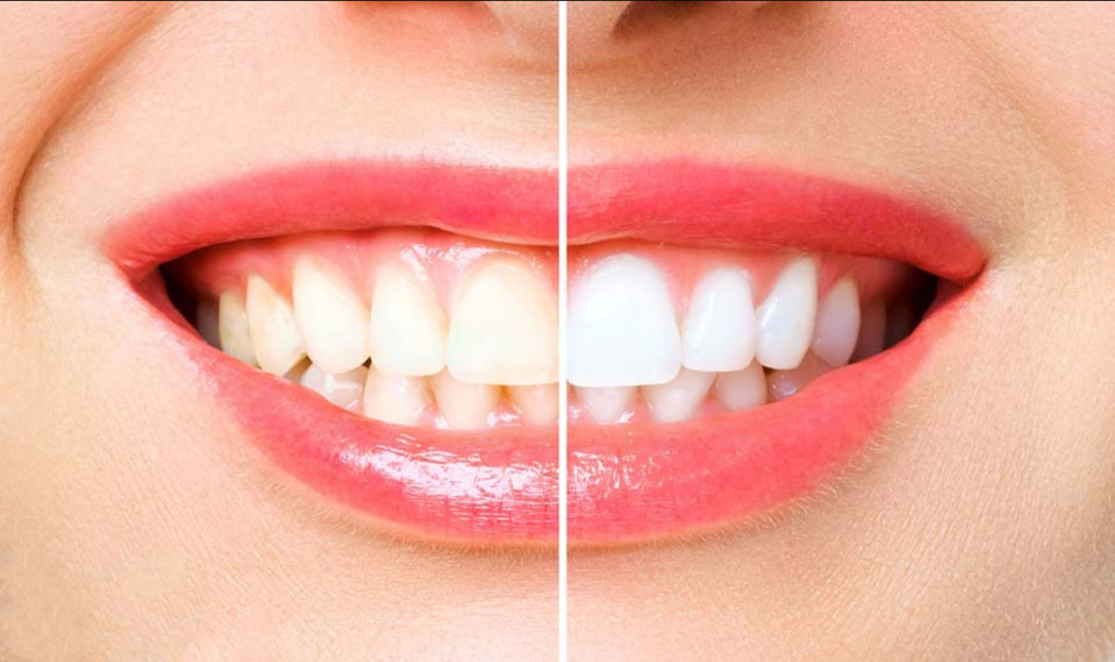 Herbs That Help In Teeth Whitening, Natural Way To A Brighter Smile, teeth Cleaning