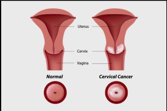 cervical cancer