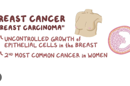 breast cancer