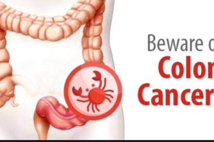 colon cancer