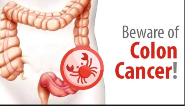 colon cancer