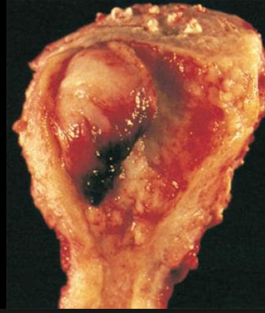 endometrial cancer