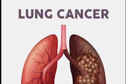 lung cancer