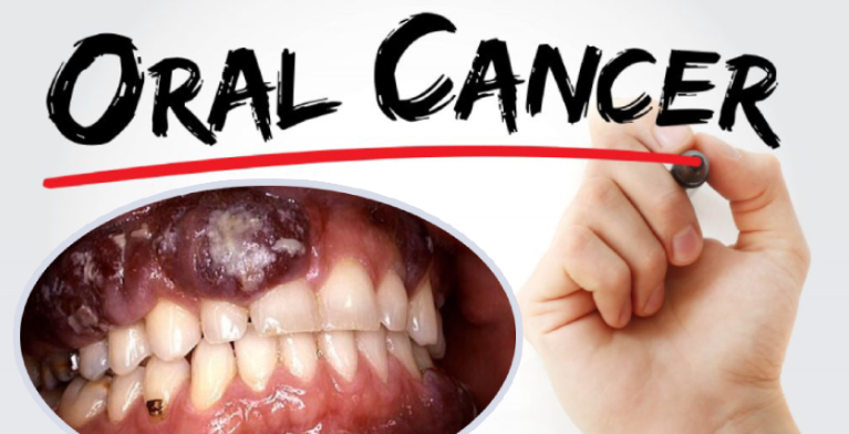 oral cancer