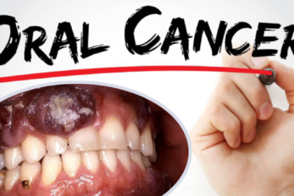 oral cancer