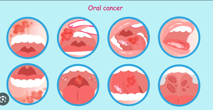 oral cancer