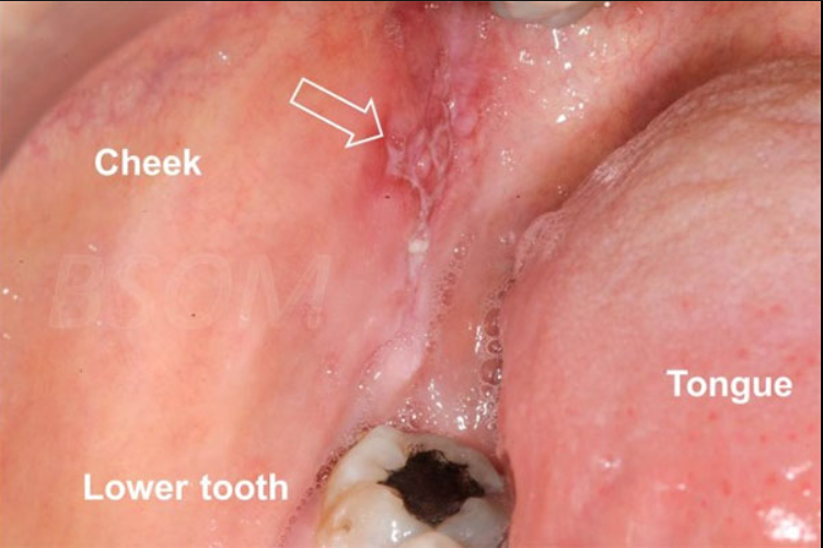 oral cancer