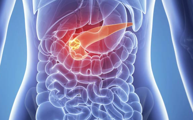 pancreatic cancer