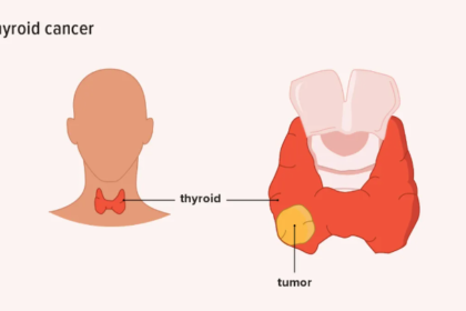 thyroid cancer