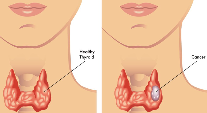 Thyroid Cancer