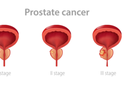 prostate cancer