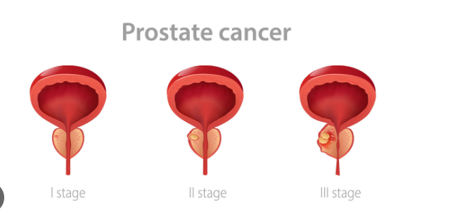 prostate cancer