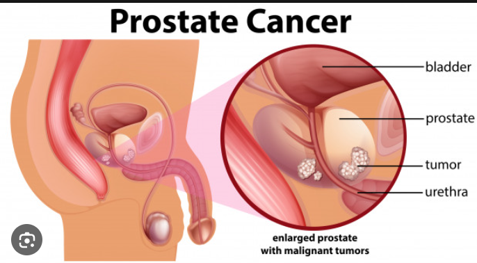 Prostate Cancer