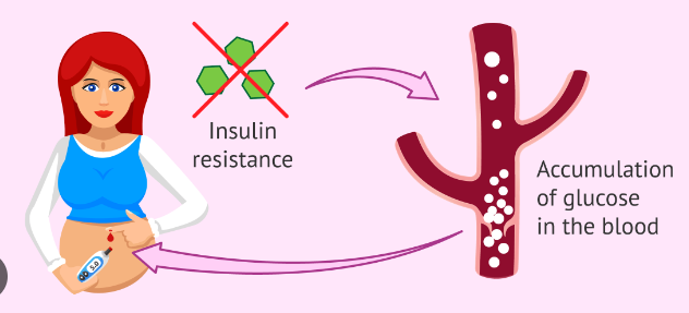 Gestational Diabetes