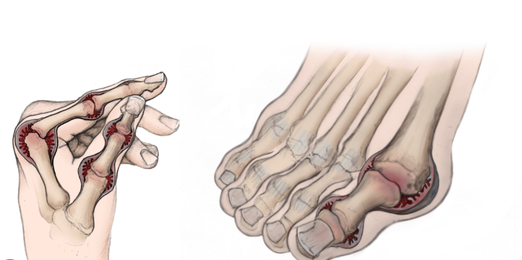  rheumatoid arthritis