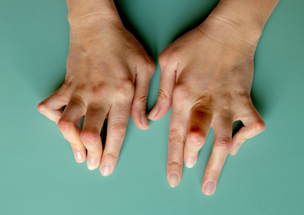  rheumatoid arthritis