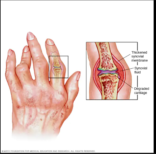  rheumatoid arthritis