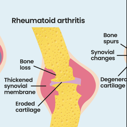  rheumatoid arthritis