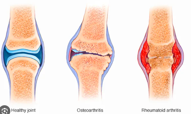  rheumatoid arthritis