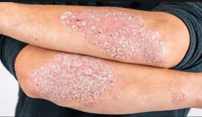 Psoriasis