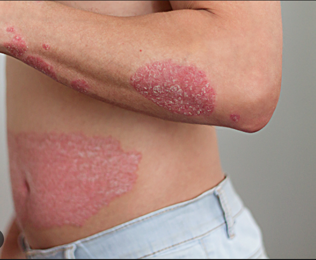 Psoriasis