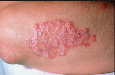 Psoriasis