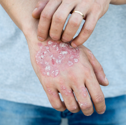 Psoriasis