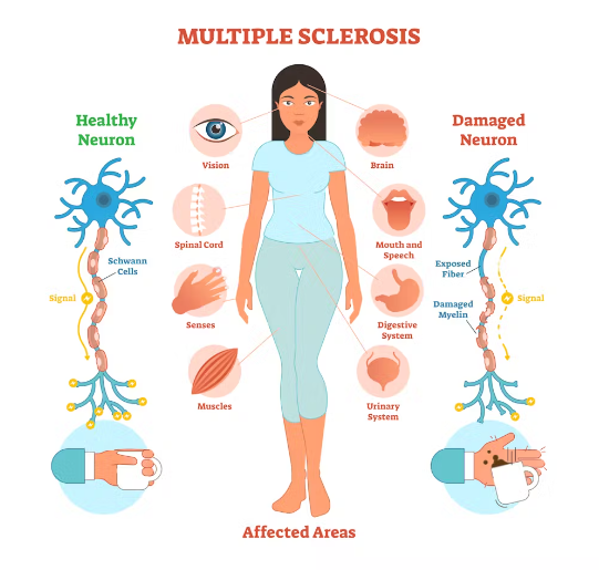 Multiple Sclerosis