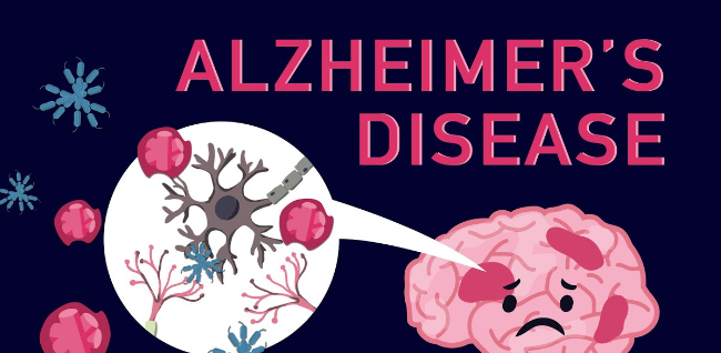 Alzheimer’s disease