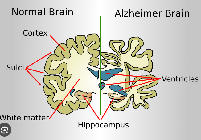 Alzheimer’s Disease