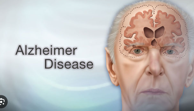 Alzheimer’s Disease