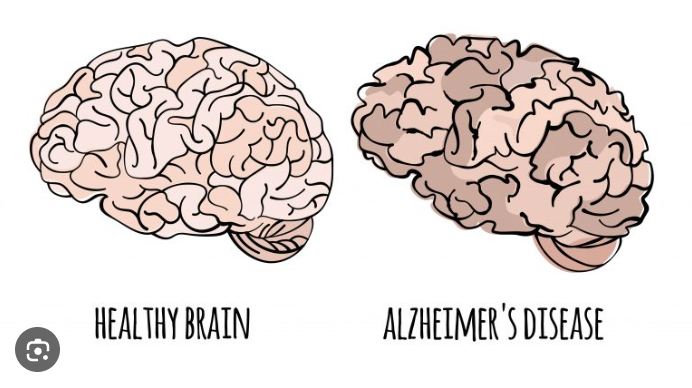 Alzheimer’s Disease