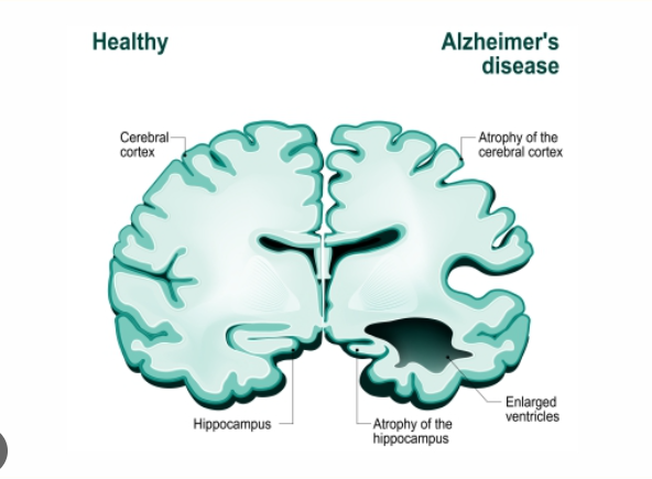 Alzheimer’s Disease