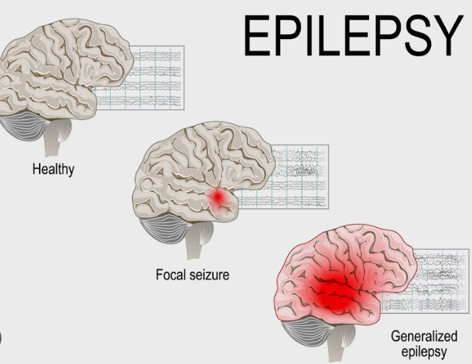 epilepsy