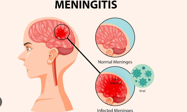 Meningitis 