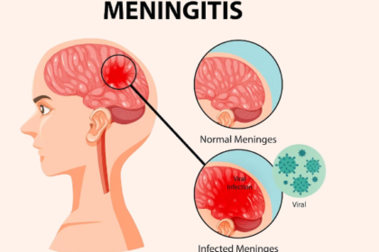 meningits