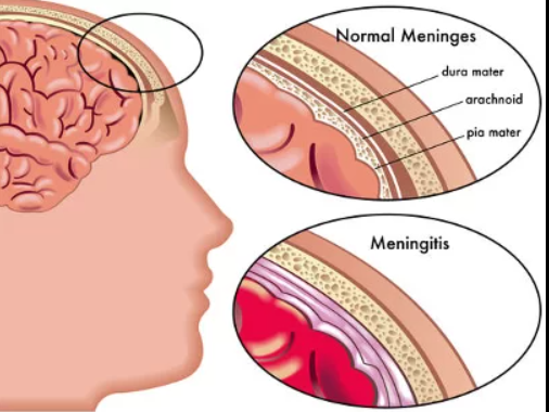 Meningitis 