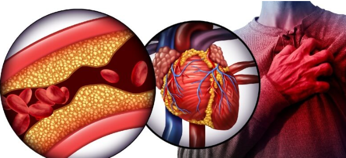 Heart Disease Risk Calculator