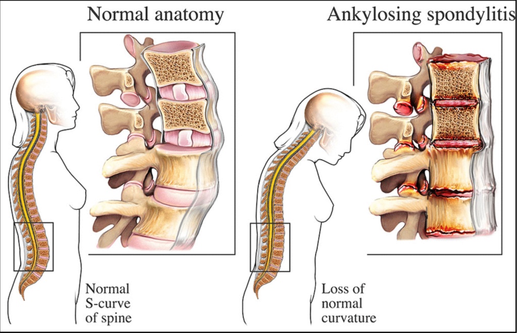 Ankylosing spondylitis