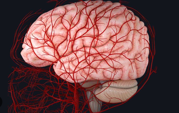 Vascular Dementia