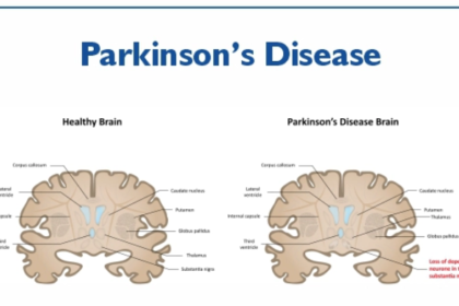 Parkinson’s Disease