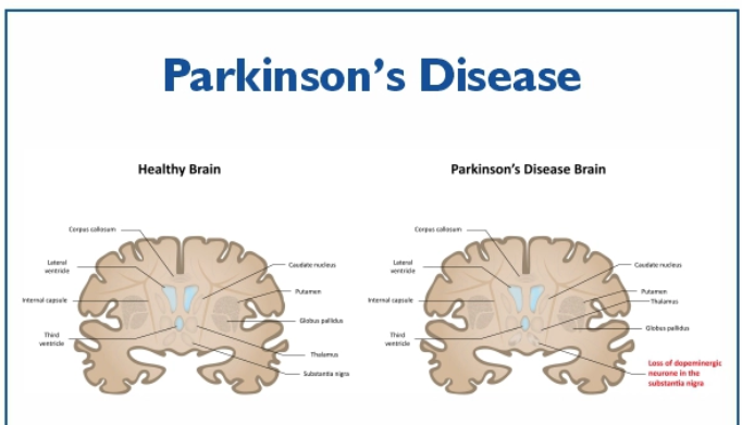 Parkinson’s Disease