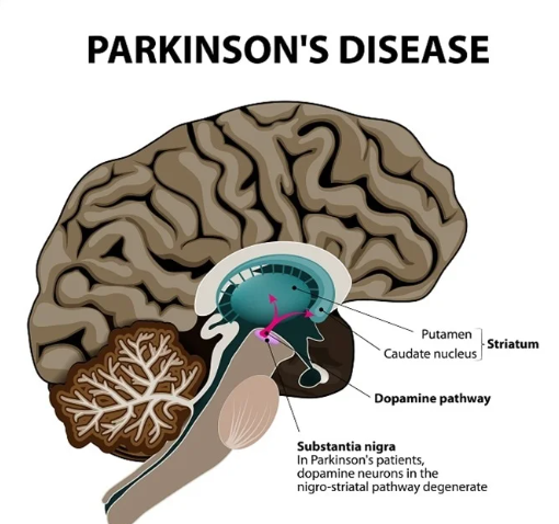 Parkinson’s Disease