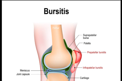 Bursitis